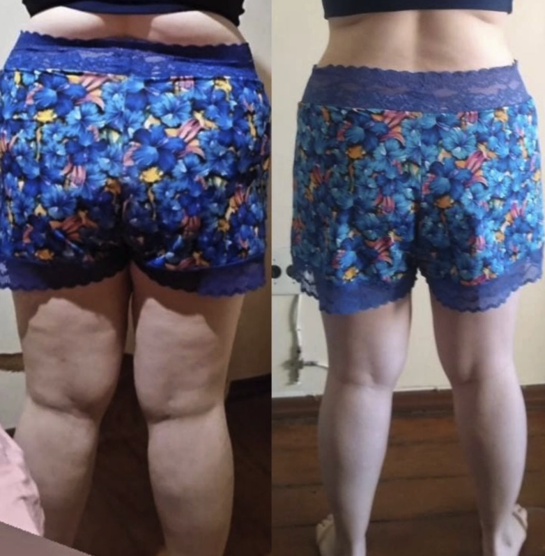 Antes e depois — caso 3